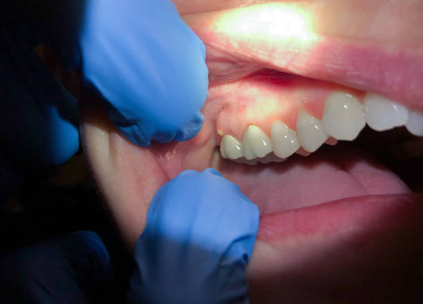 Best Emergency Dental Care for Broken or Chipped Teeth in Morton, WA